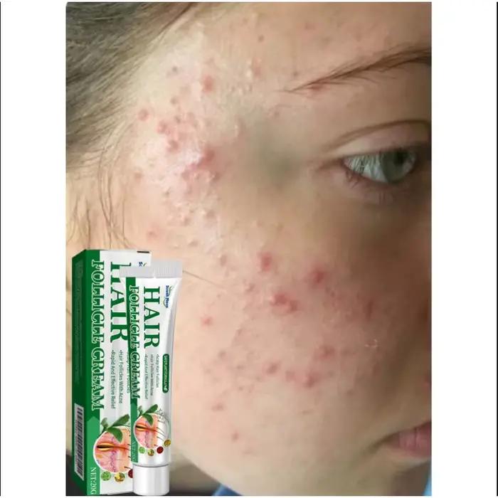 Crème Anti-acné élimine efficacement les Nodules de la peau Pustules Cysts Papules points noirs hommes et femmes acné