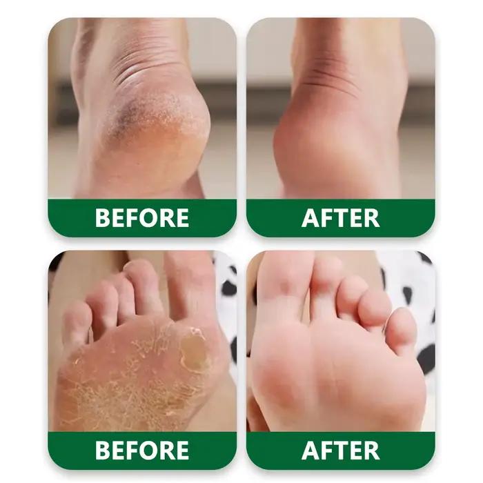 Crème pour les pieds à l'huile d'arbre à thé