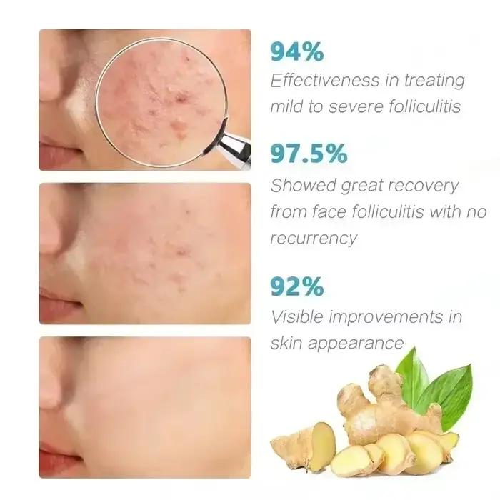 Crème Anti-acné élimine efficacement les Nodules de la peau Pustules Cysts Papules points noirs hommes et femmes acné