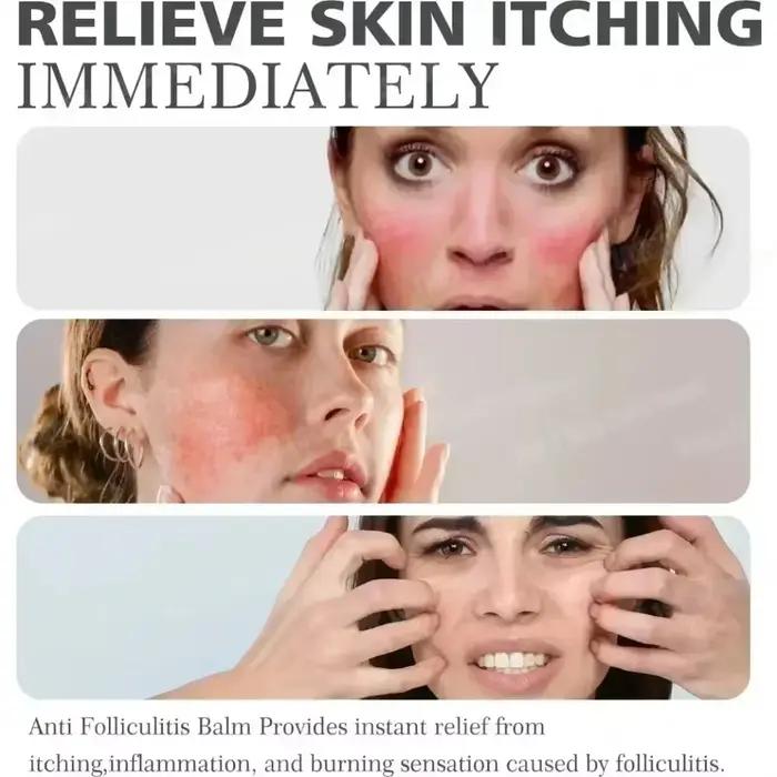 Crème Anti-acné élimine efficacement les Nodules de la peau Pustules Cysts Papules points noirs hommes et femmes acné