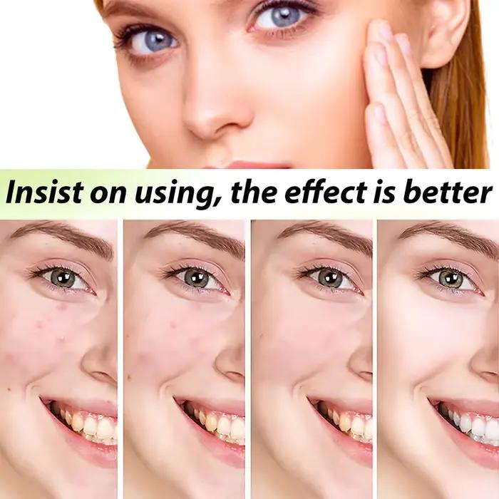 3ème crème Anti-acné efficace élimine les Nodules de la peau Pustules Cysts Papules points noirs hommes et femmes acné