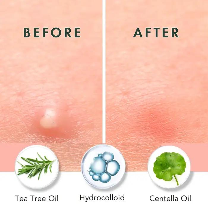 Patch anti-acné à l'huile essentielle d'arbre à thé 12/36 Hydrogel