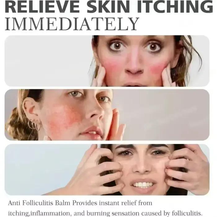3ème crème Anti-acné efficace élimine les Nodules de la peau Pustules Cysts Papules points noirs hommes et femmes acné
